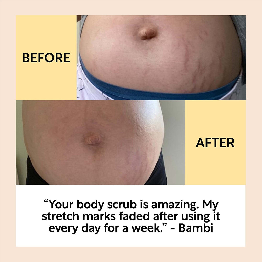 Before and after comparison of stretch marks on a person's stomach with a testimonial below.