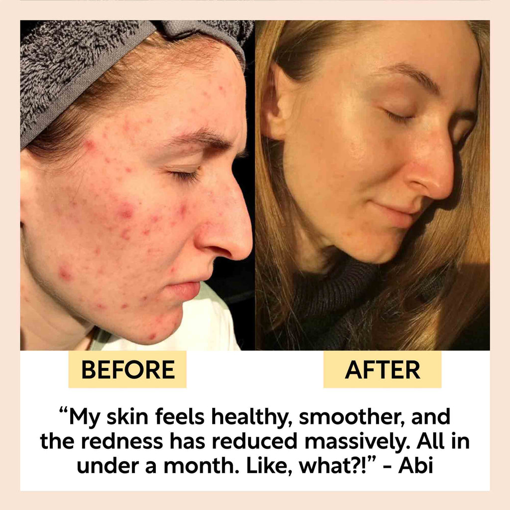 Before and after comparison of a person's face with text indicating improvement in skin health.