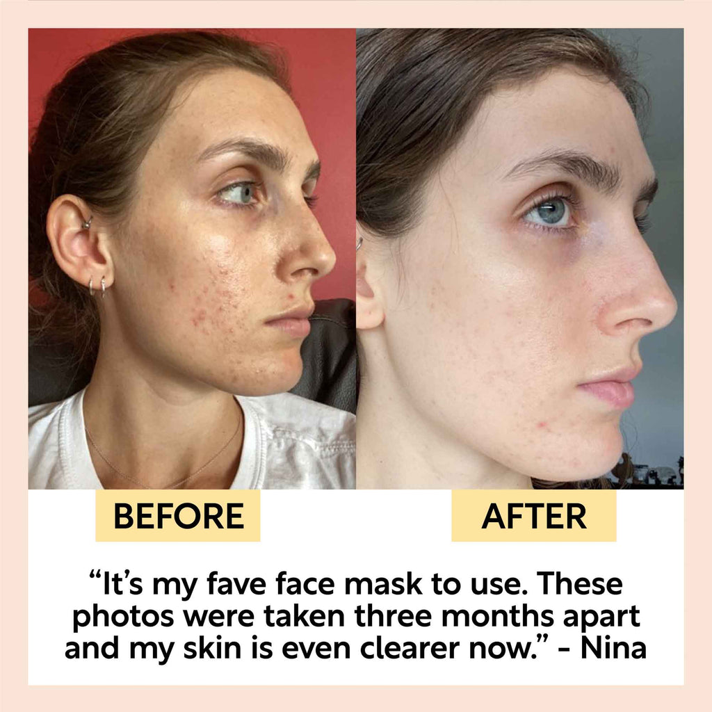 Before and after comparison of a woman's face with text about a face mask.