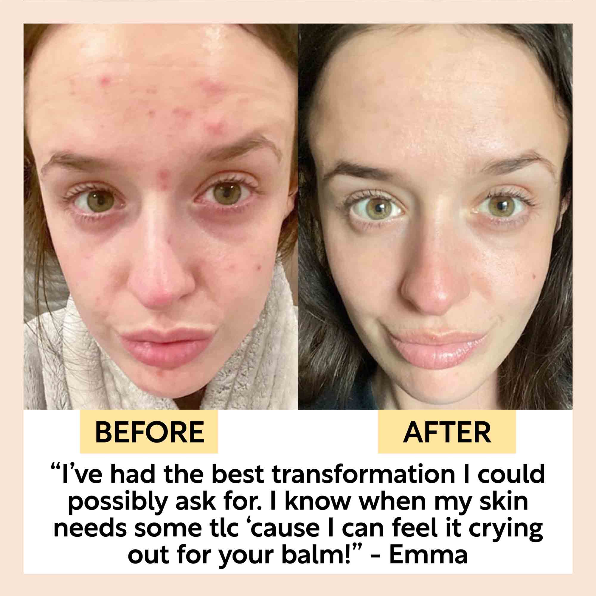 Before and after comparison of a woman's face with text about skin transformation and balm use.