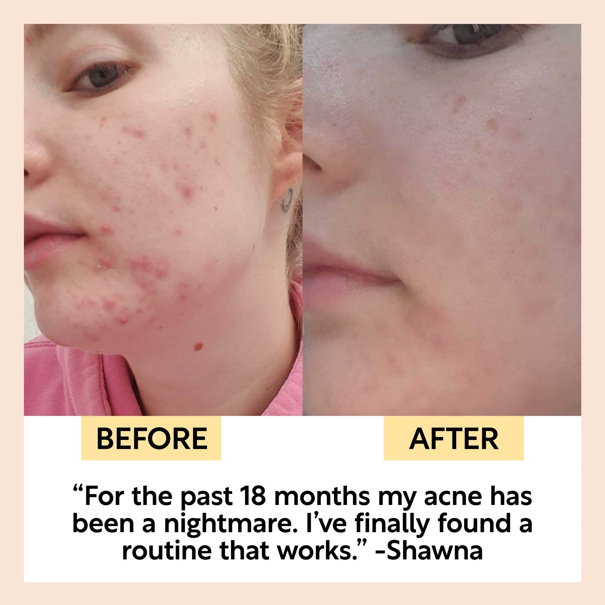 Before and after comparison of acne on a person's face with text and quote.