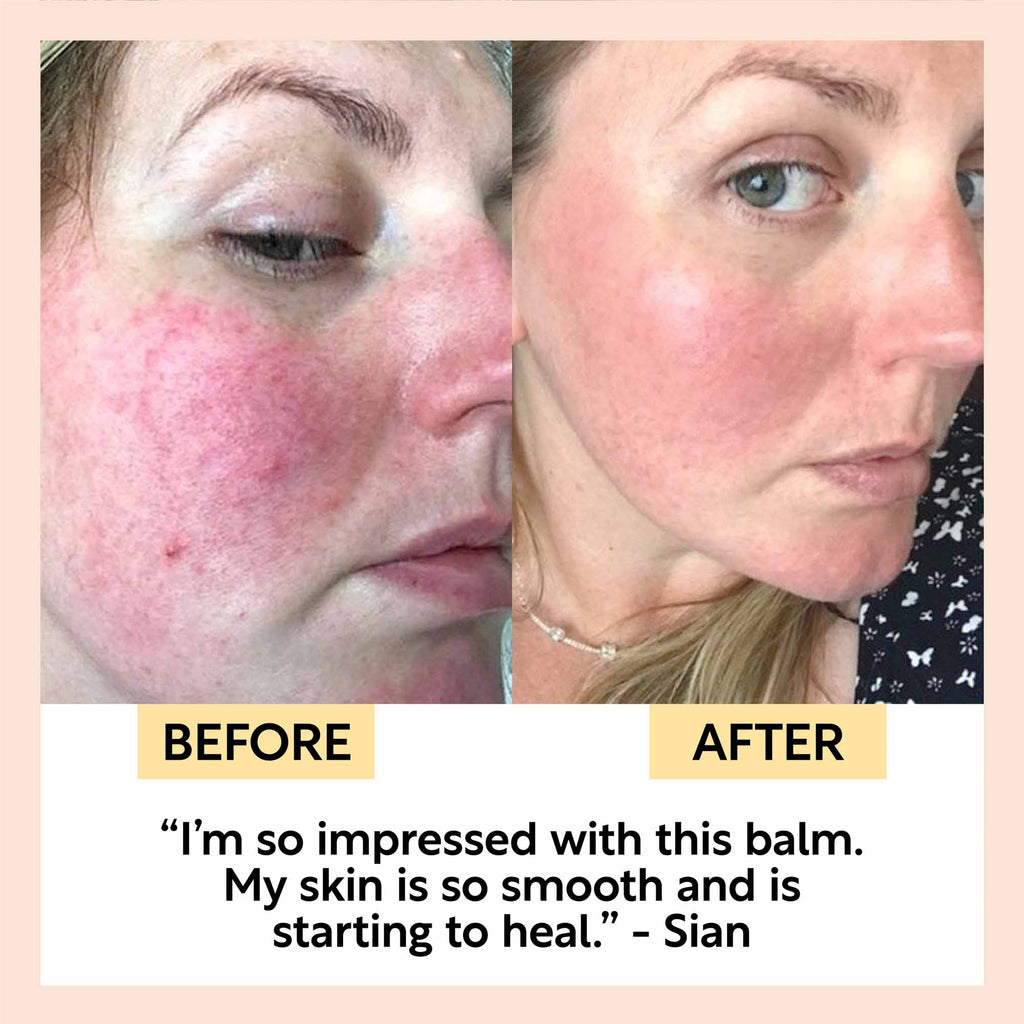 Before and after comparison of a person's face with visible skin condition improvement, featuring a quote from Sian.