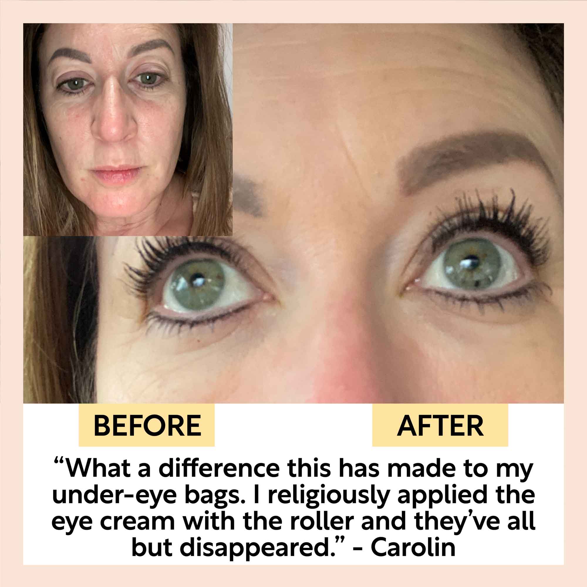 Before and after comparison of under-eye bags with text about eye cream effectiveness.