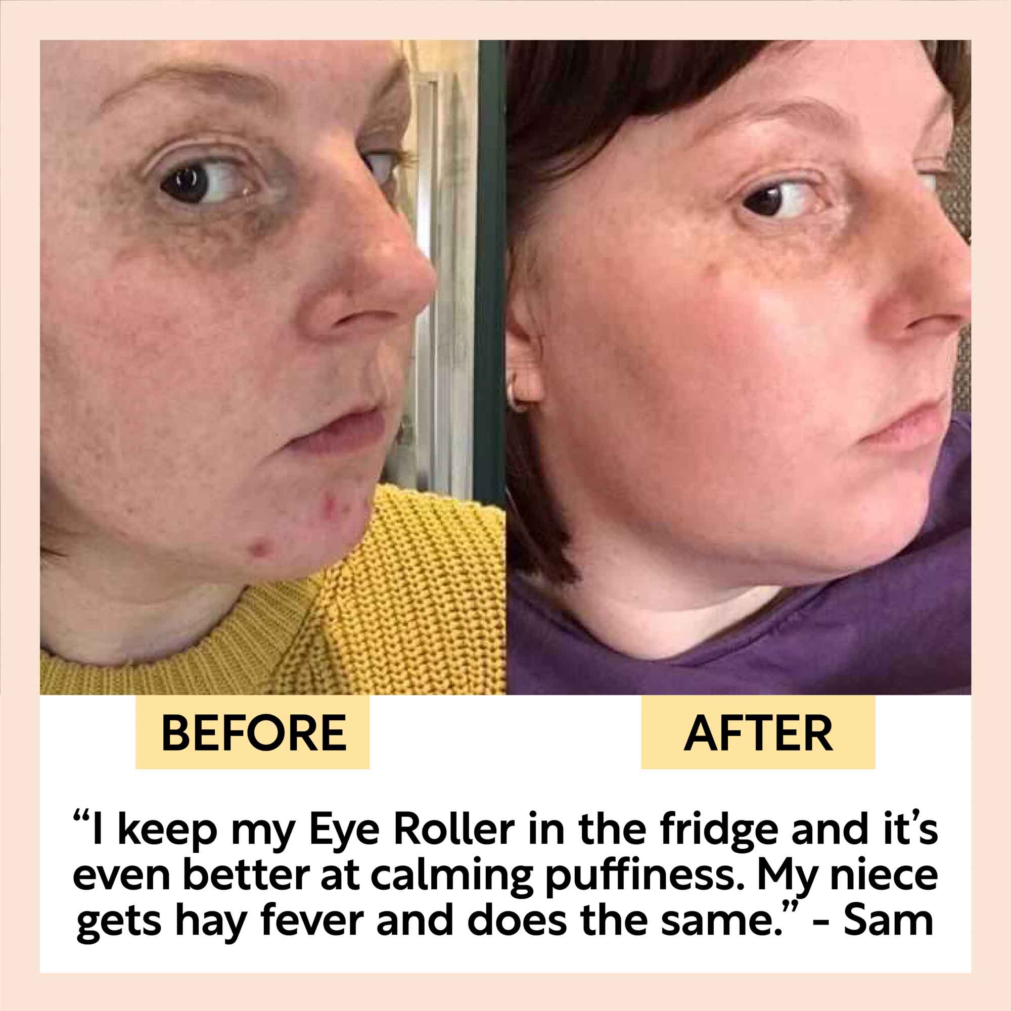 Before and after comparison of a person's face with text about using an eye roller.