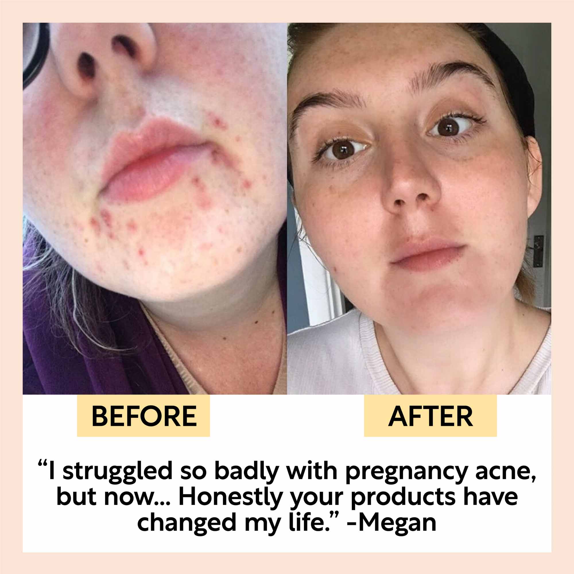 Before and after comparison of a person's face with acne, showing a positive transformation.
