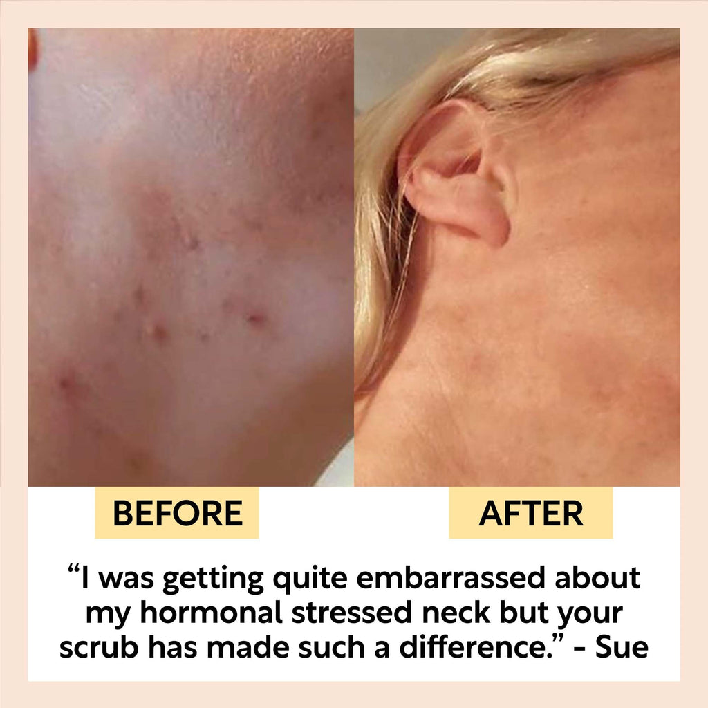 Before and after comparison of a neck with acne, showing a positive transformation.
