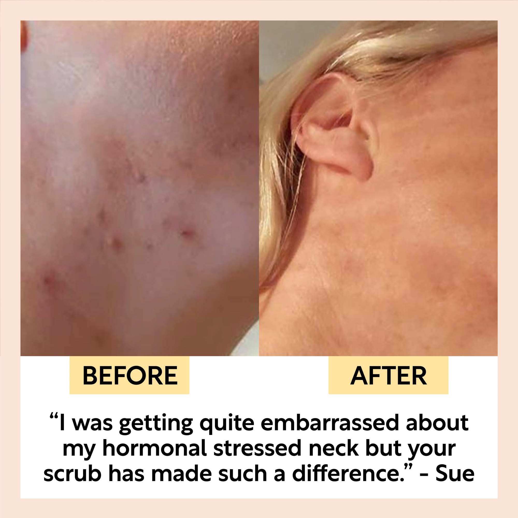 Before and after comparison of a neck with acne, showing a positive transformation.