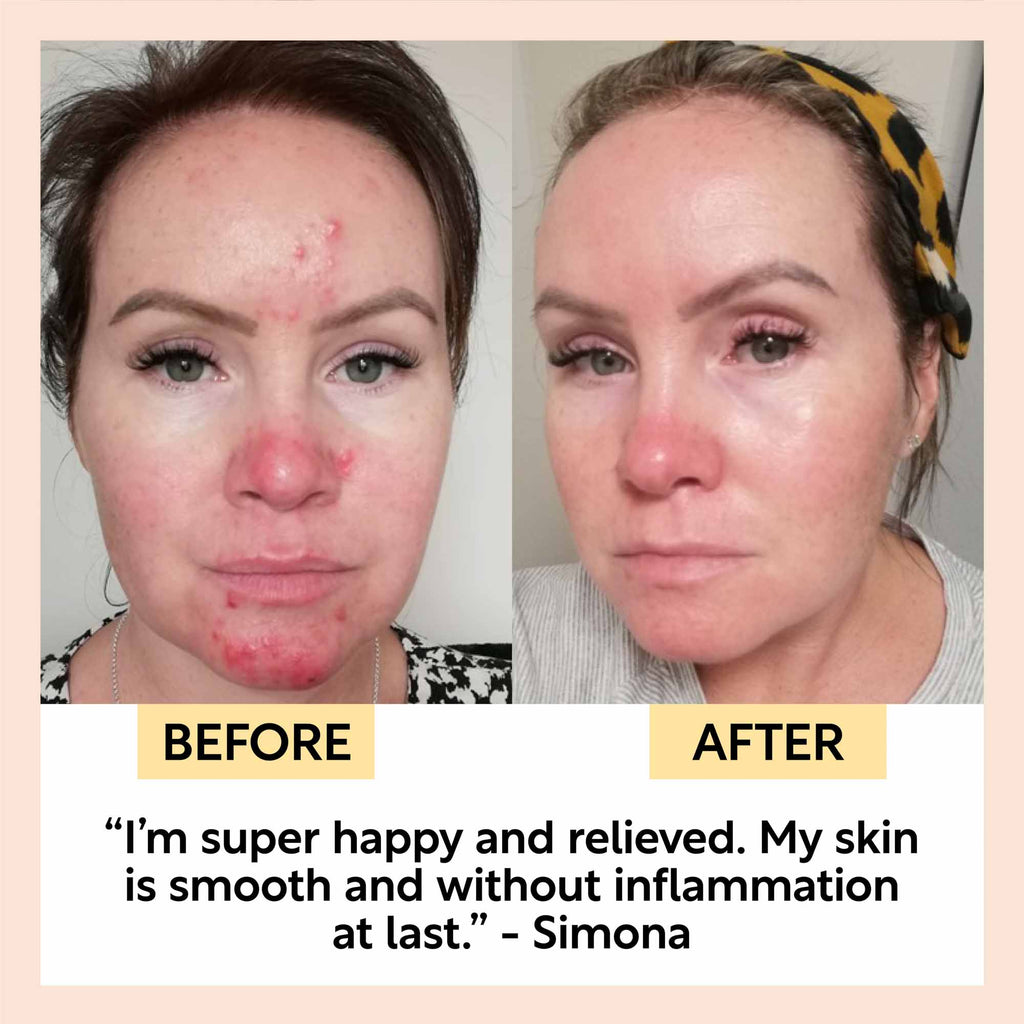 Before and after comparison of a woman's face with text indicating improvement in skin condition.